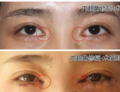 小姐姐内眼角修复多少钱,小姐姐整形投资大揭秘